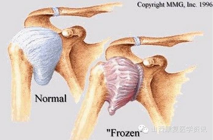 康复科处理肩周炎的治疗原则和特效技术(图1)